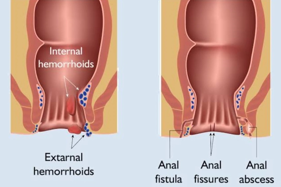Piles, also referred to as haemorrhoids, are swollen veins inside the anal canal (internal heamorrhoids) or around the anus (external haemorrhoids). Piles can either be treated using lifestyle changes, ointments, non-surgical techniques or in some cases through surgery., Best Gastro Surgeon Ahmedabad, Best Gatroenterologist Ahmedabad, Best Liver Surgeon Ahmedabad, Liver Surgery Ahmedabad, Best Liver Surgeon Ahmedabad, Weight Loss Clinic Ahmedabad, Best Weight Loss Clinic Ahmedabad, Best Weight Loss Center Ahmedabad, Weight Loss center Ahmedabad, Dr Avinash Tank, Gatroenterologist in Ahmedabad, Gatroenterologist Ahmedabad, Best Laparoscopy Surgeon in Ahmedabad